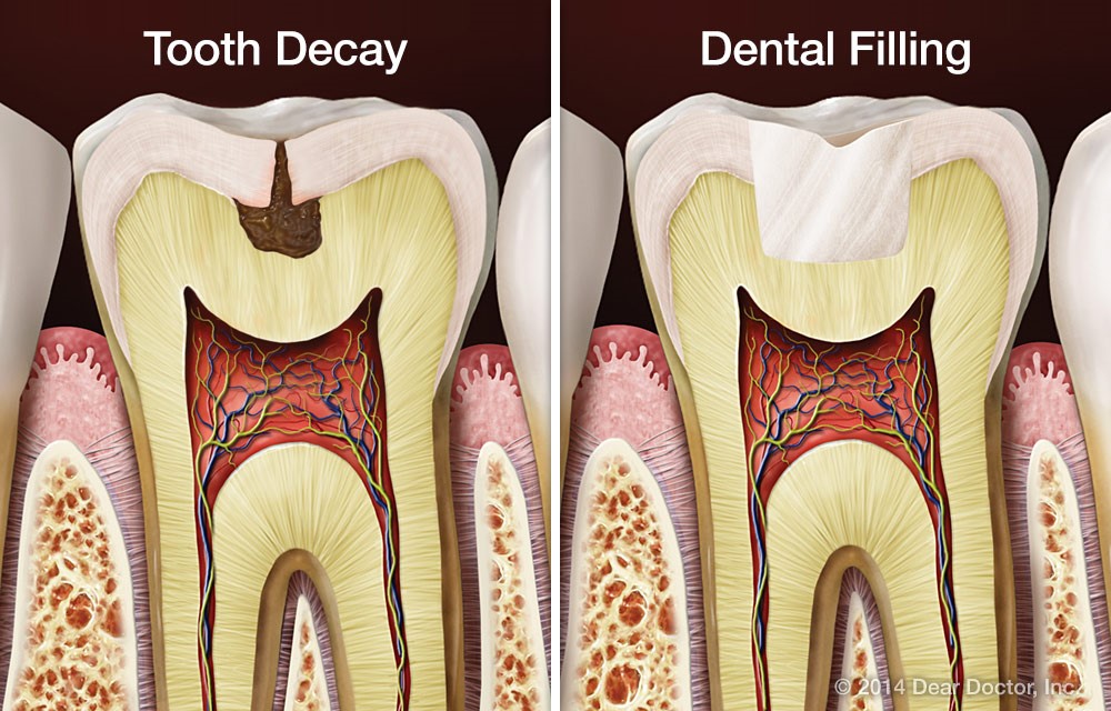 Filling Restoration At Seymour Dental Centre In Blenheim Marlborough NZ