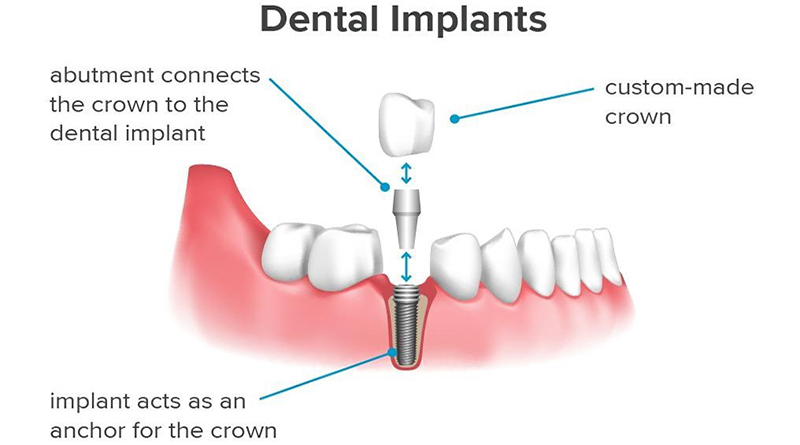 Implant Diagram At Seymour Dental Centre In Blenheim Marlborough NZ