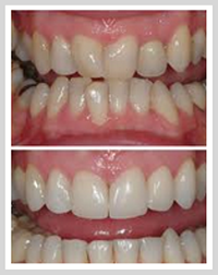 Invisalign Orthodontics Results At Seymour Dental Centre In Blenheim Marlborough NZ