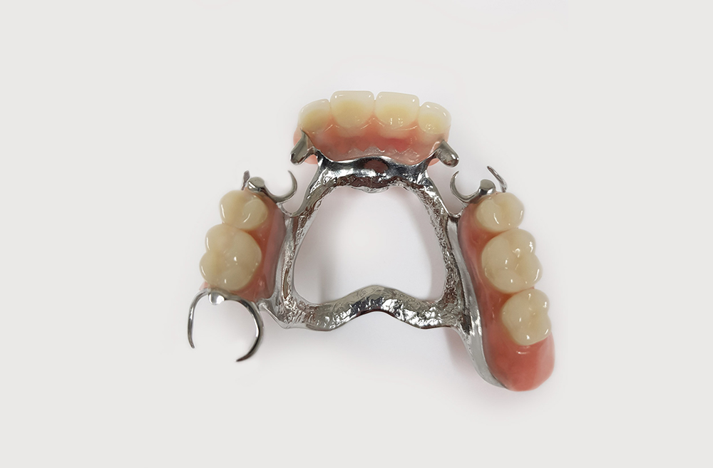 Metal Frame Partial Dentures At Seymour Dental Centre In Blenheim Marlborough NZ