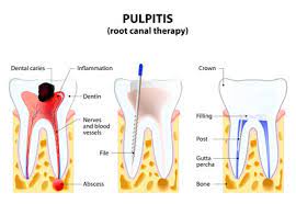 Root Canal Treatment At Seymour Dental Centre In Blenheim Marlborough NZ