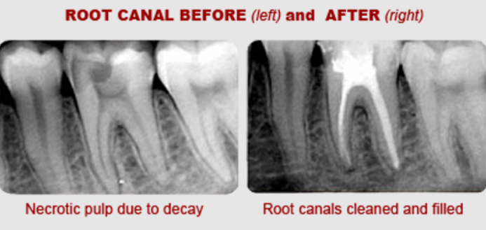 Root Canal Treatment Xray At Seymour Dental Centre In Blenheim Marlborough NZ