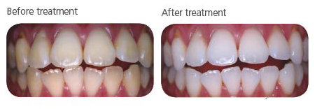 Teeth Whitening Treatment At Seymour Dental Centre In Blenheim Marlborough NZ